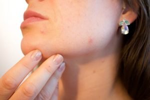 hoe kan je acne voorkomen